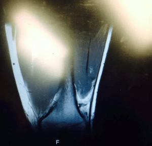 'King' Bobby Green X-Ray